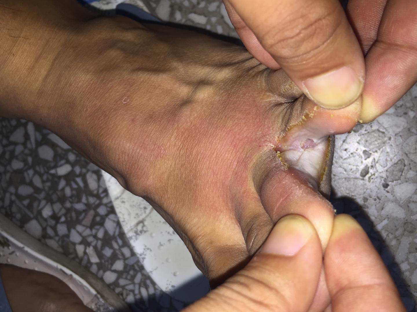 脚气不当回事儿出现细菌感染导致丹毒就麻烦大了