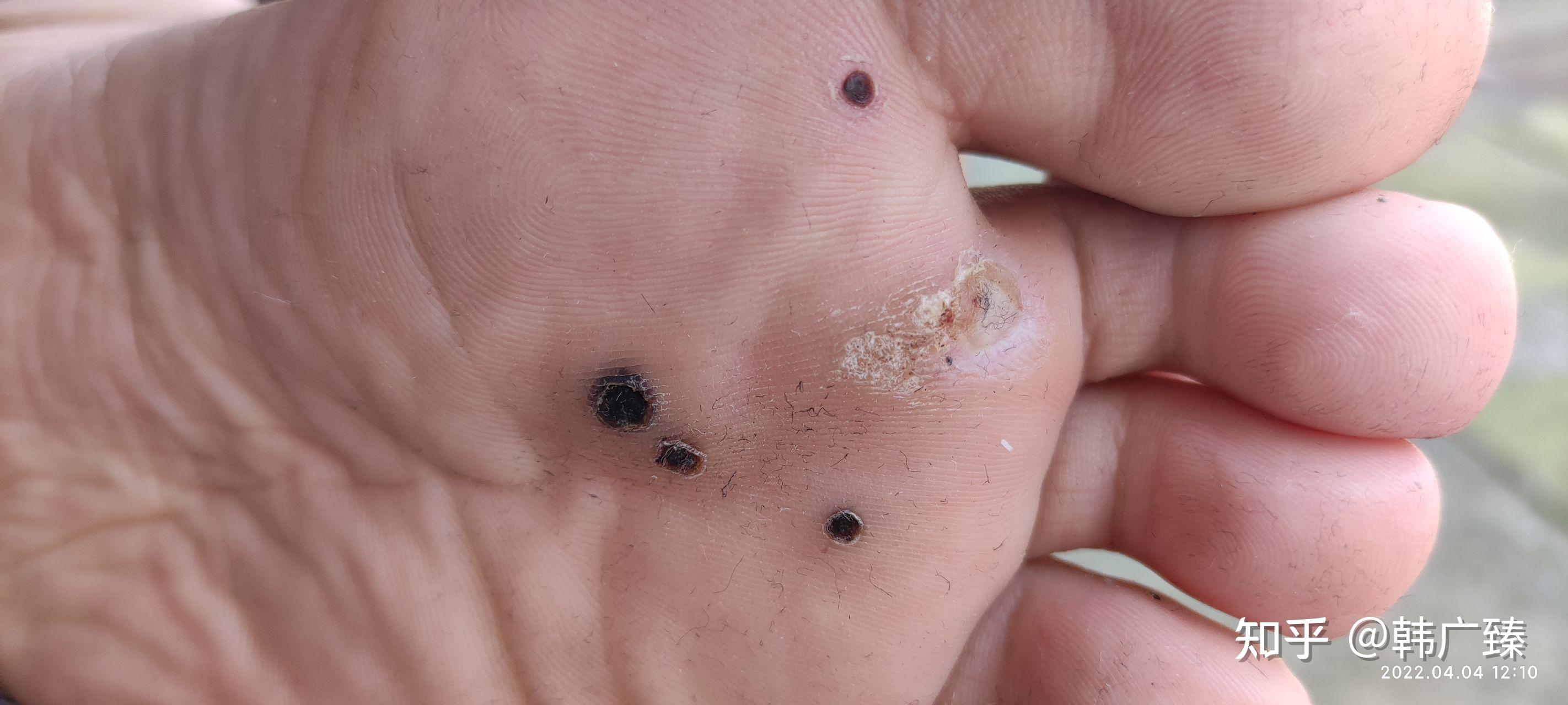 4.4/已经20天了,马上就要去再做母疣另一半了.