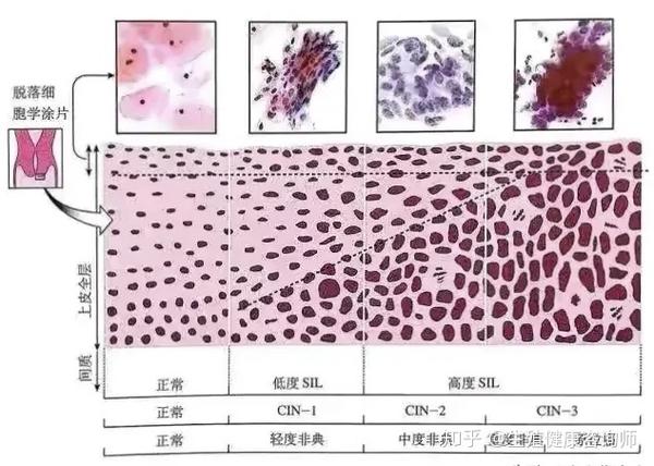 教你看tct检查报告单