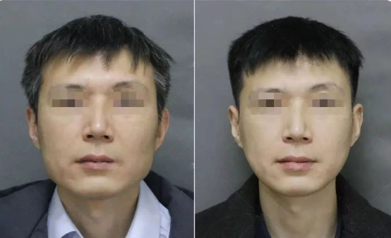 01  颧骨颧弓手术:保留颧骨高点,矢量高位截骨,软组织复位提升保留