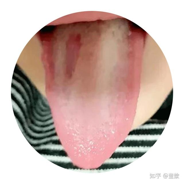 孩子的舌苔属于"地图舌"吗? - 知乎