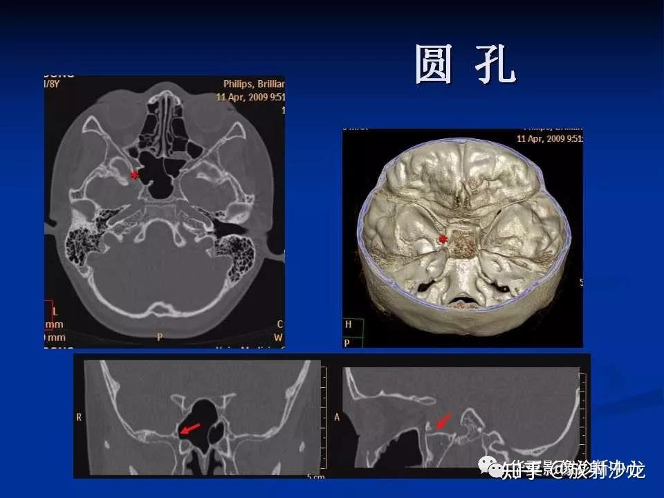 实用、详细的颅底各孔道影像解剖! - 知乎