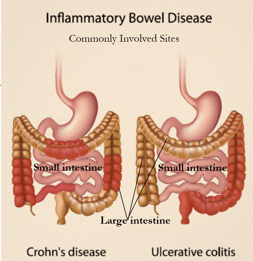 IBD IBD
