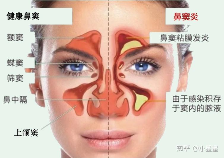 额窦气化图片