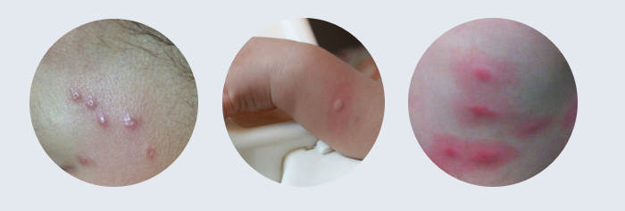 夏天蚊虫叮咬常见症状及处理