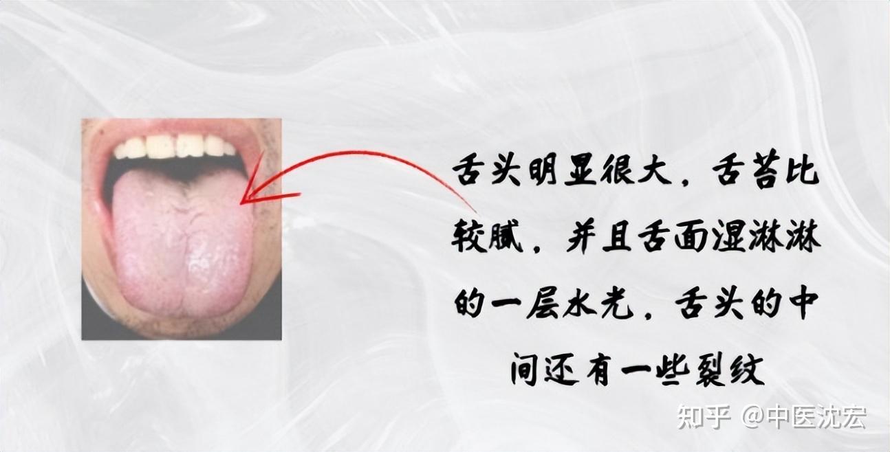 痰湿一祛,万病全消,老中医清痰除痰的绝招,痰湿体质看过来 - 知乎