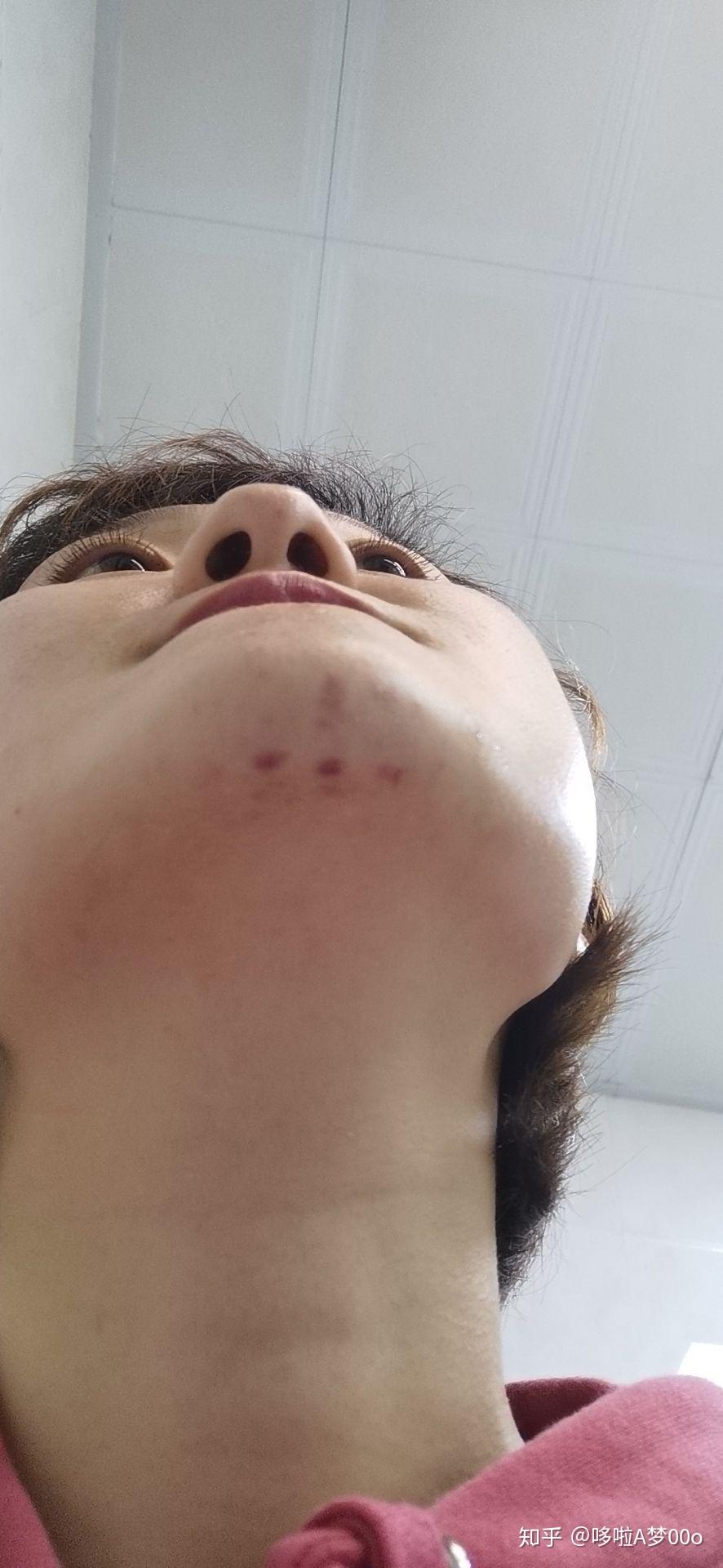 最近无缘无故突然发现下巴有一块类似淤青的东西室友突然看到的说像是