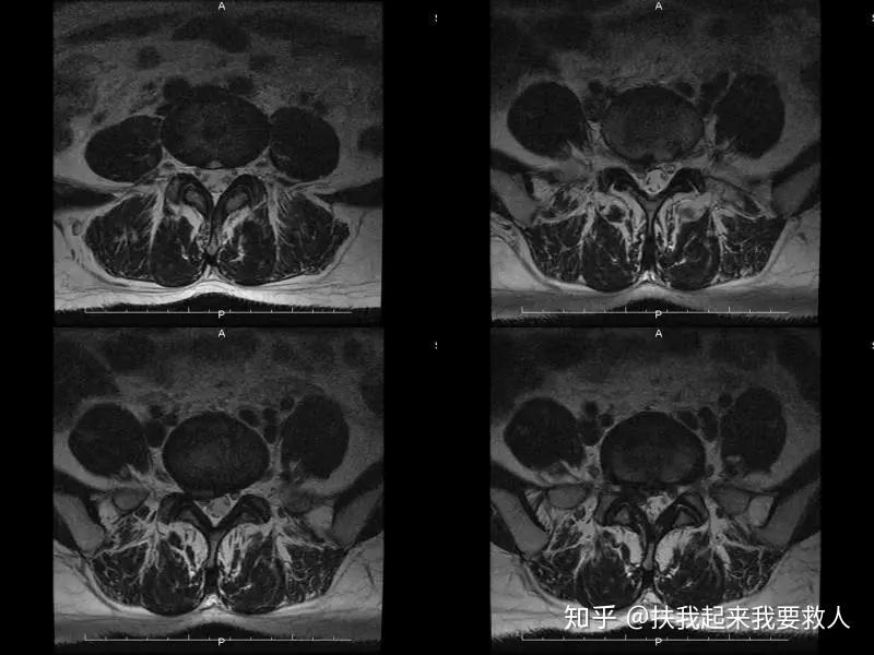 間盤突出症輔助檢查:(腰椎mri):l4-5輕微突出;l5-s1椎間盤後右側脫出