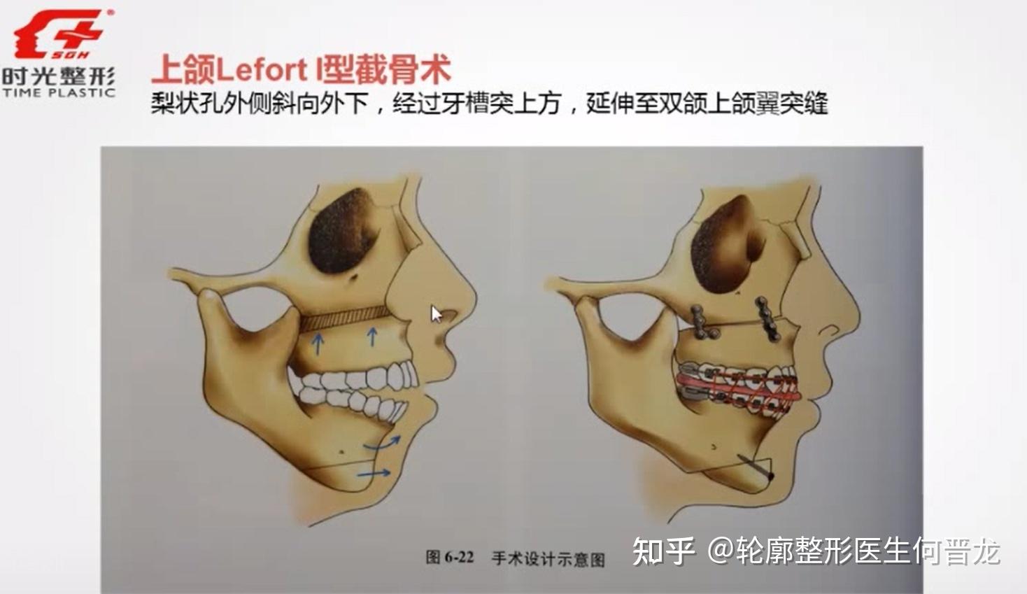 上颌根尖下(前段)截骨术下颌根尖下(前段)截骨术双颌前段截骨术下颌升