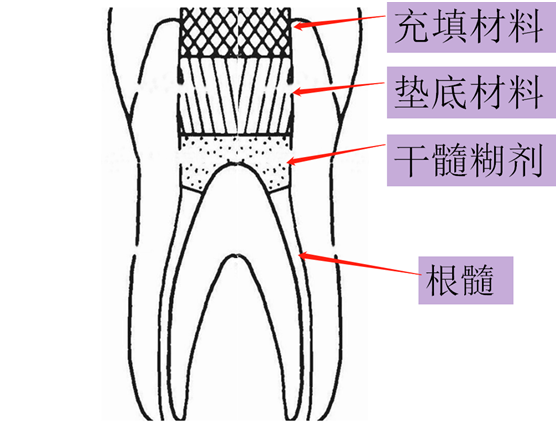 故干髓术的适应症没有根管治疗那么广泛,由于临床上对牙髓状态判断