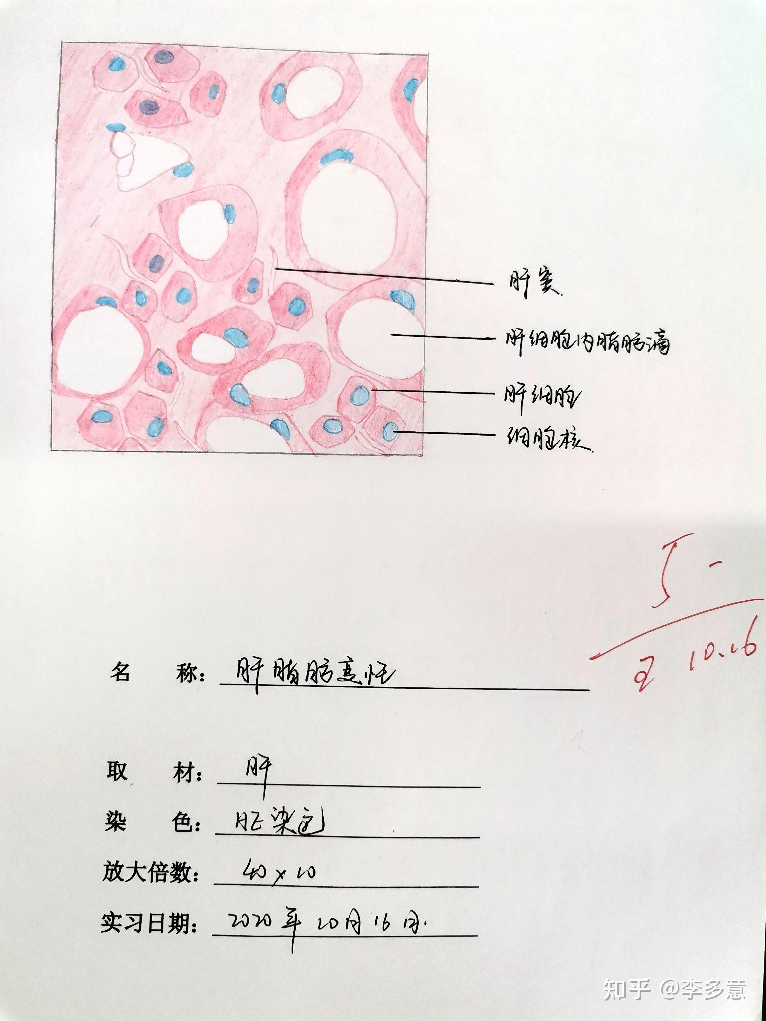 肺粟粒性結核胃潰瘍門脈性肝硬化慢性腎小球腎炎肝脂肪變性蜂窩織炎