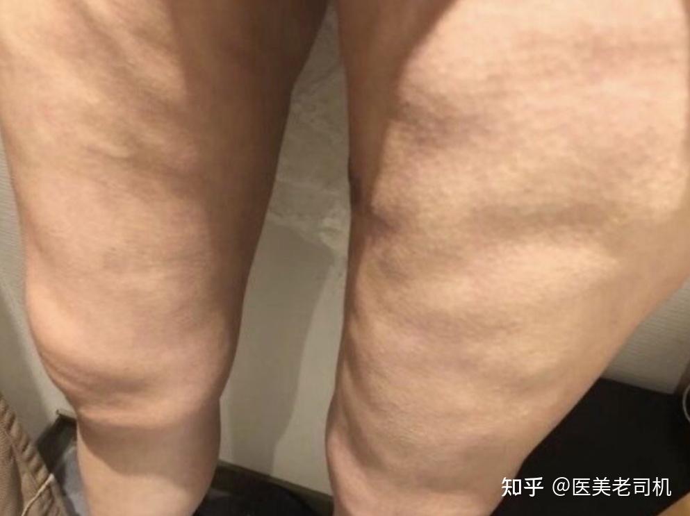 广州哪位医生做大腿吸脂手术好啊