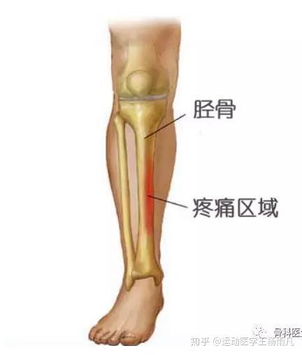 小腿骨头一按就疼 知乎