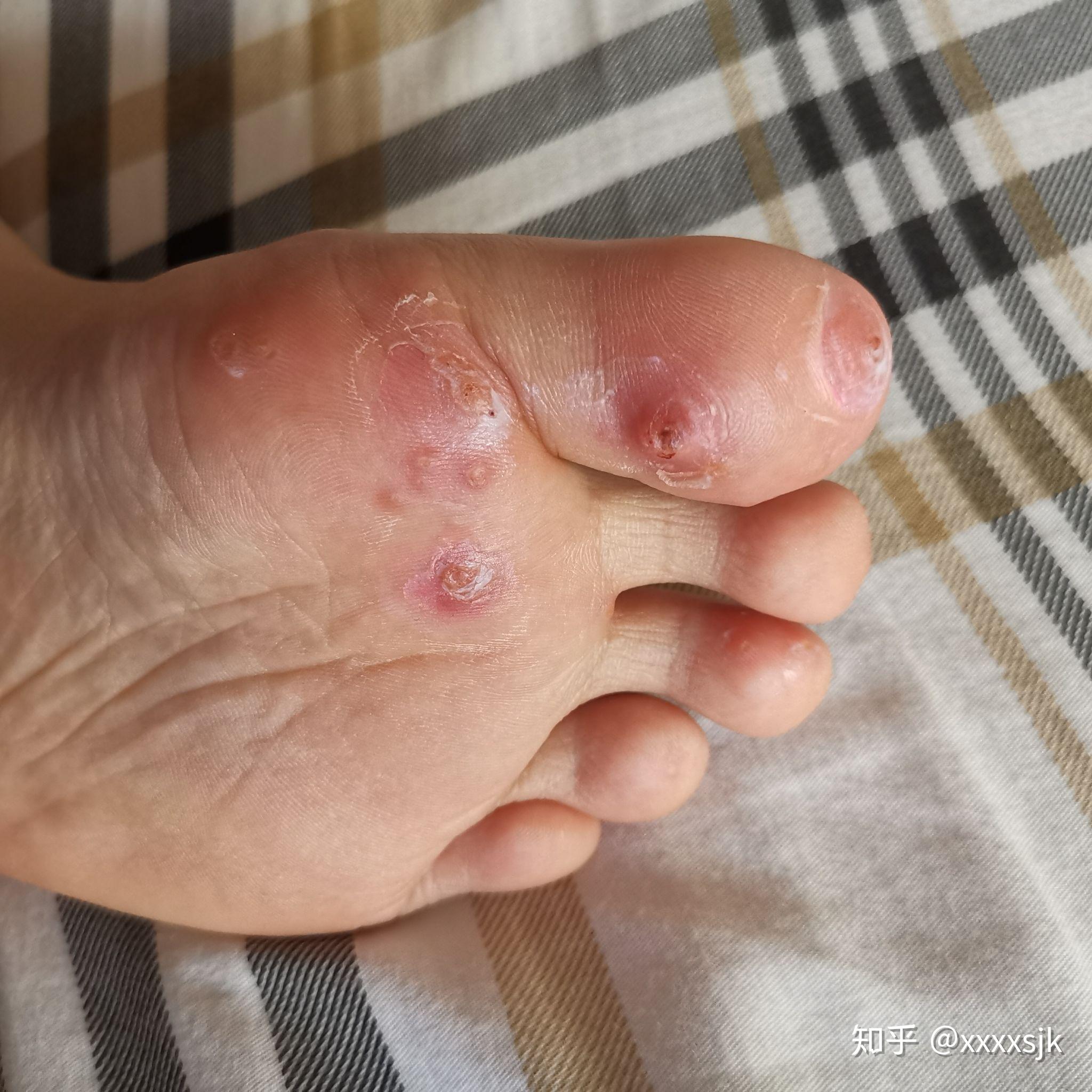 治鸡眼记录 - 知乎