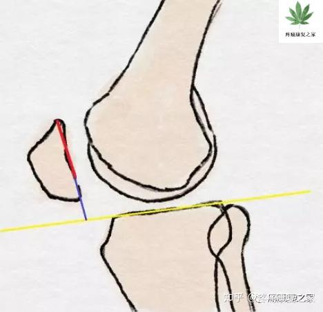 膝关节重要参数测量 - 知乎