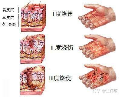 二级烧伤是什么程度图片