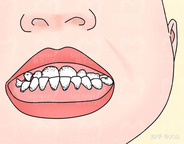 【暨大穗华口腔科普】地包天是怎么形成的?最佳治疗是什么时候? - 知乎