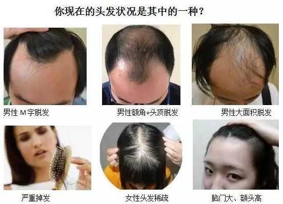 治疗秃顶最好的方法是在合适的时间做适合的治疗方式