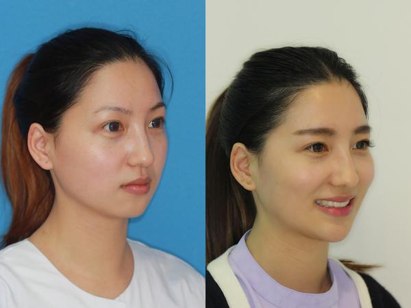 做过牙齿正畸的同学们,你们的脸型变了吗?