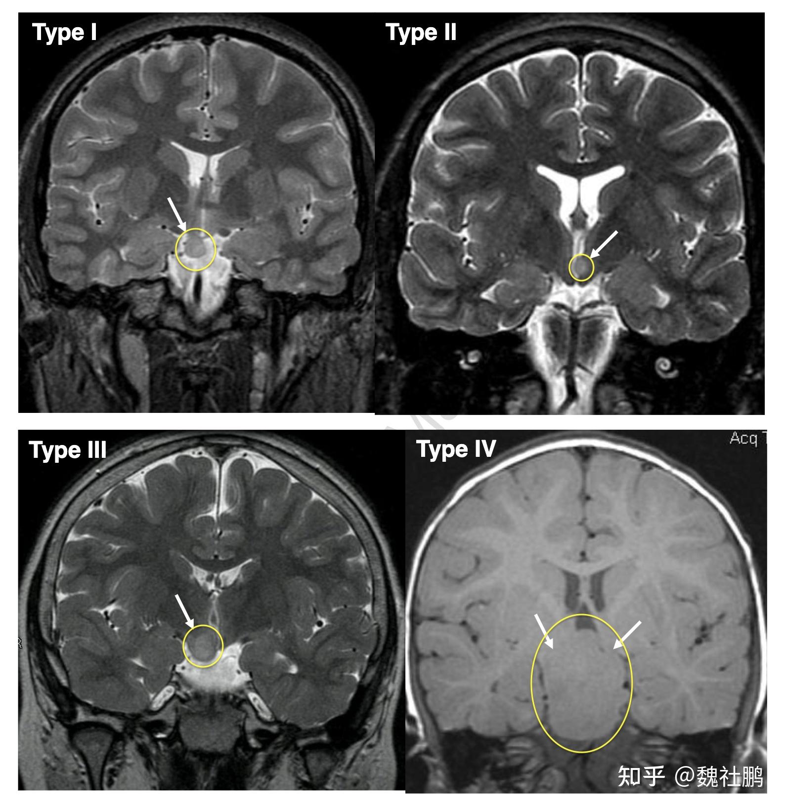 下丘脑错构瘤图片