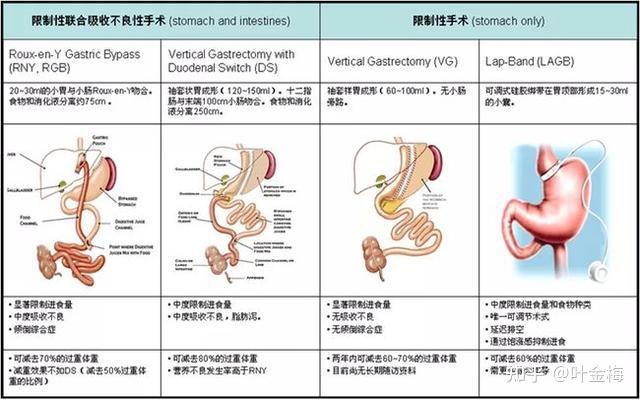 毕二式吻合图解输入袢图片