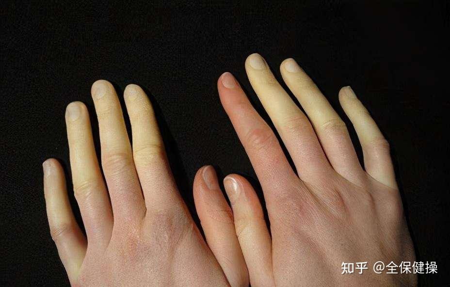 表现为四肢发凉,凹陷性水肿,皮肤苍白而粗糙,伴有心动过缓,乏力,食欲