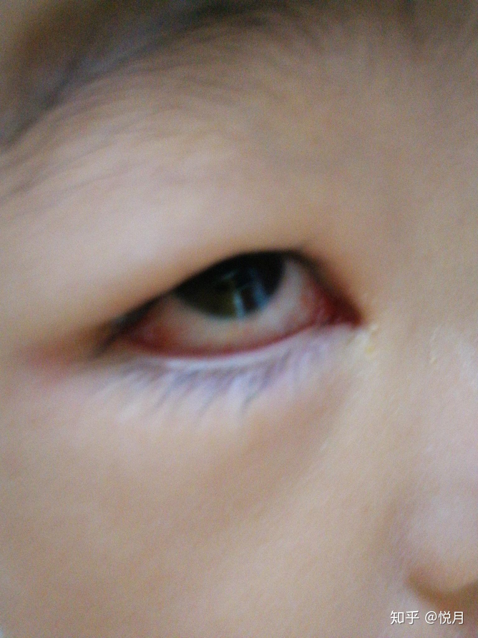 得了红眼病如何用药？急性结膜炎有什么症状？|得了|红眼病-知识百科-川北在线