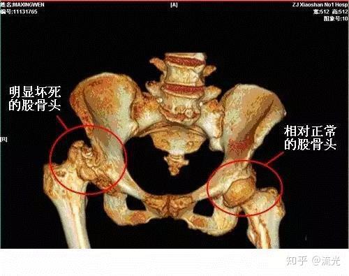 股骨头坏死后股骨头变形塌陷怎么办