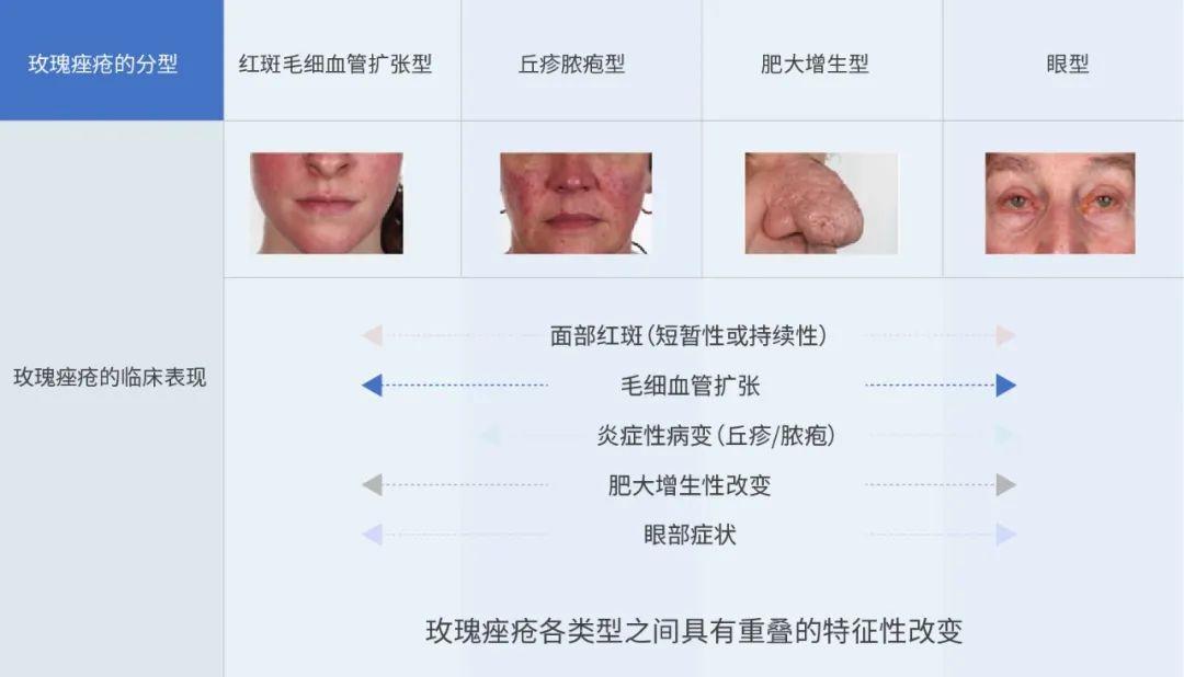 玫瑰痤疮国内外临床诊断标准及治疗策略