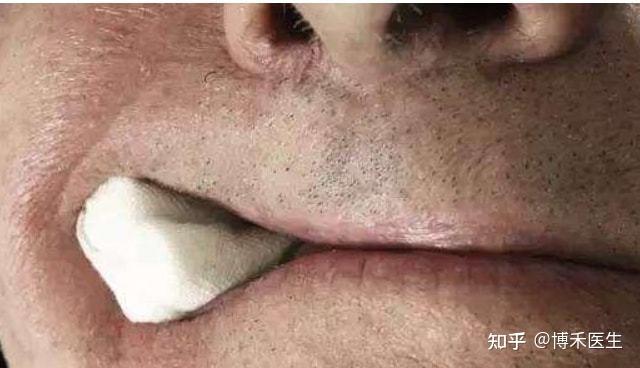 拔牙后需咬住1-2条棉卷,目是为了压迫止血及保护伤口,约40分钟左右