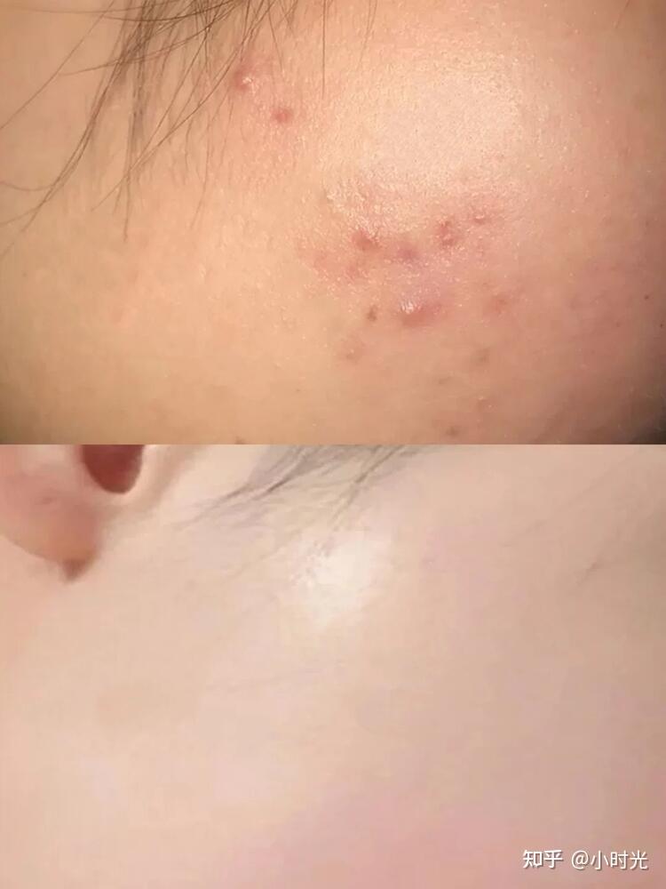 2,熬夜长痘怎么办?