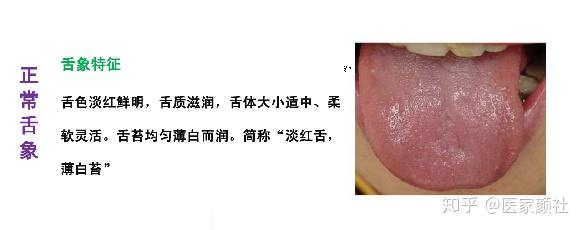 如何通过舌苔来判断身体健康与否?最全舌像来了,一分钟教你学会所有舌像! - 知乎
