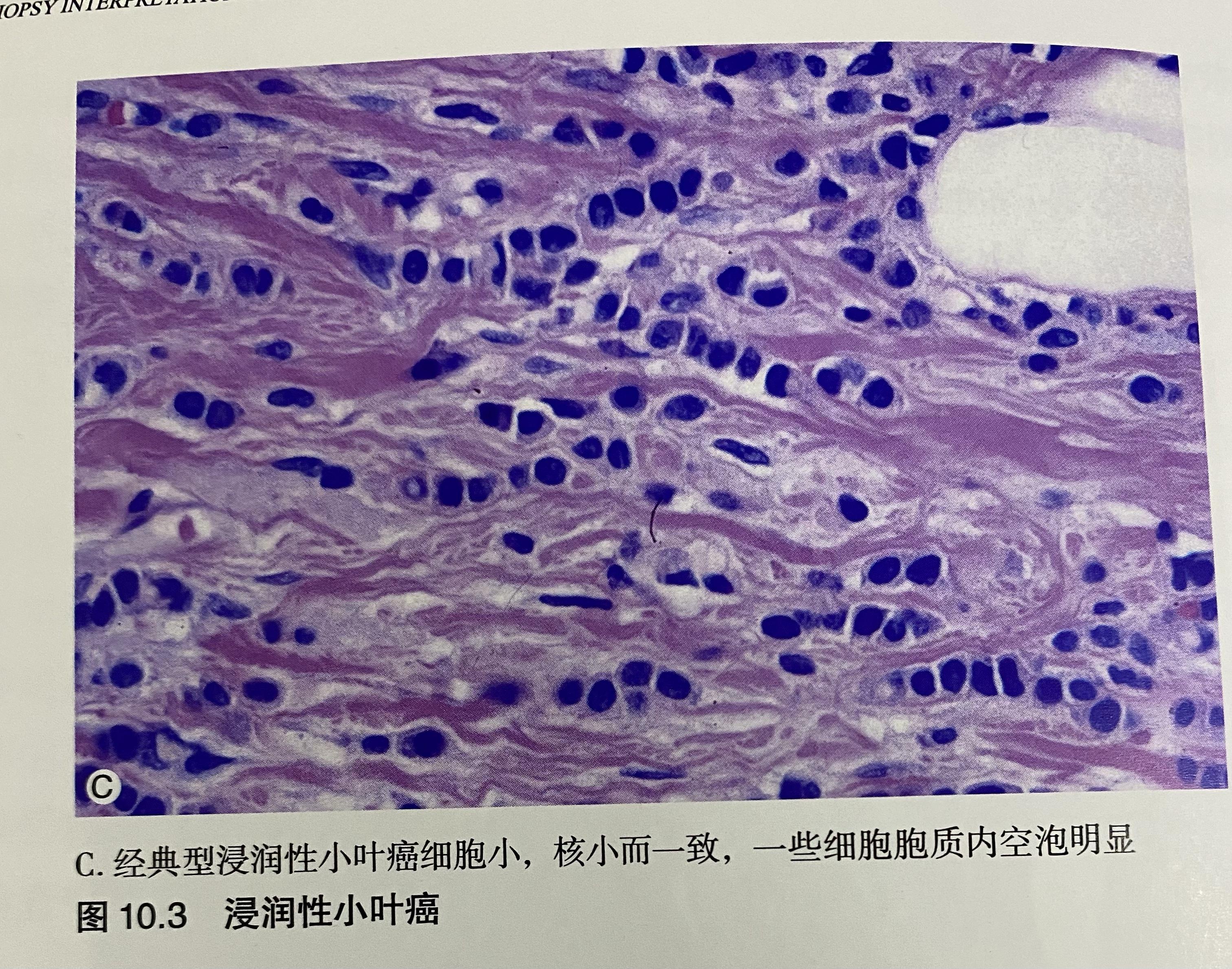 乳腺癌病理切片图片