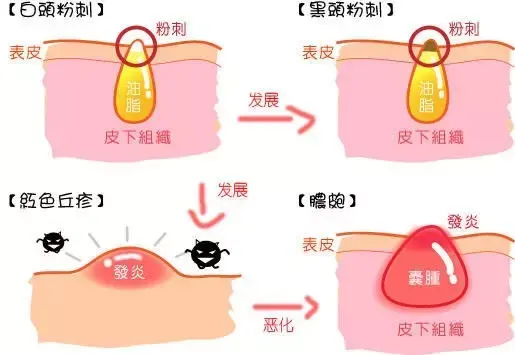 如何消除闭口粉刺? - 知乎
