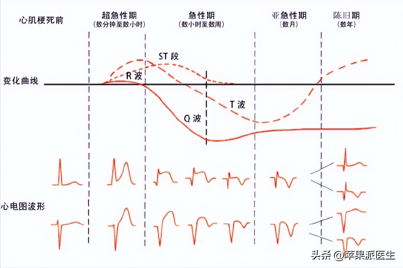 心肌萎缩图片手绘图图片