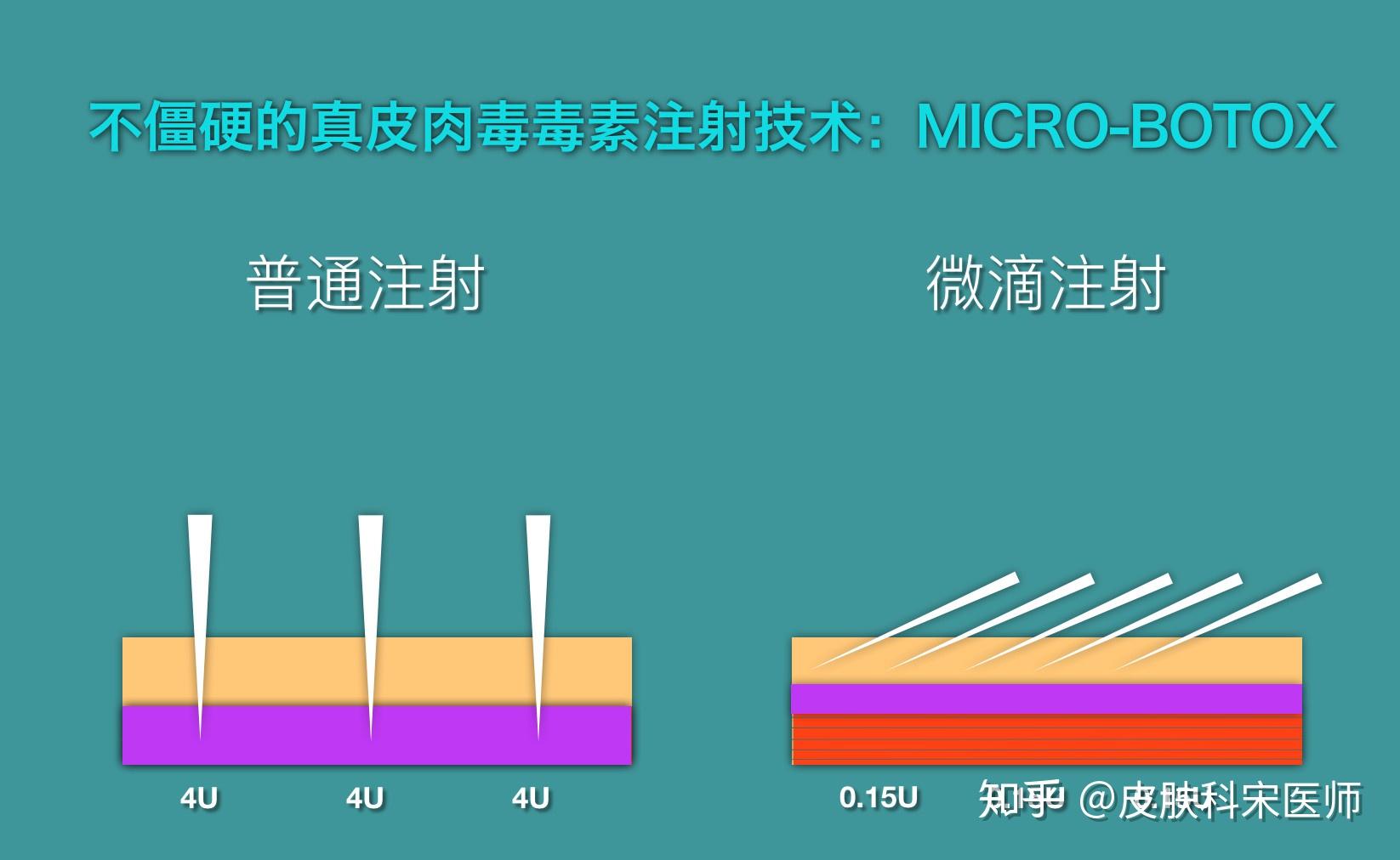 注射线提升下颌多久恢复_下颌线注射提升_打针下颌线提升