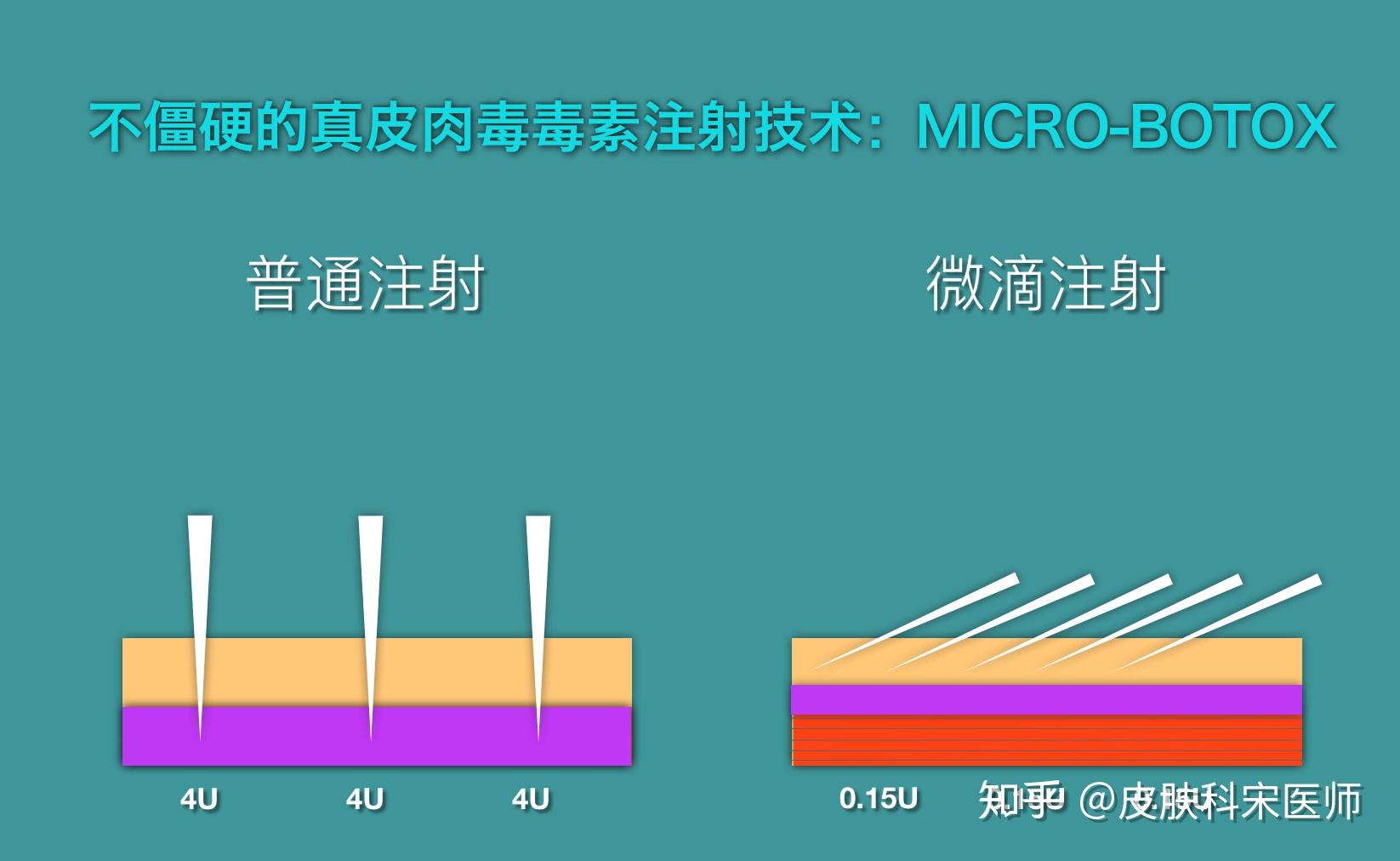 来点干货 你想知道的肉毒“瘦脸针”粉肉 - 知乎