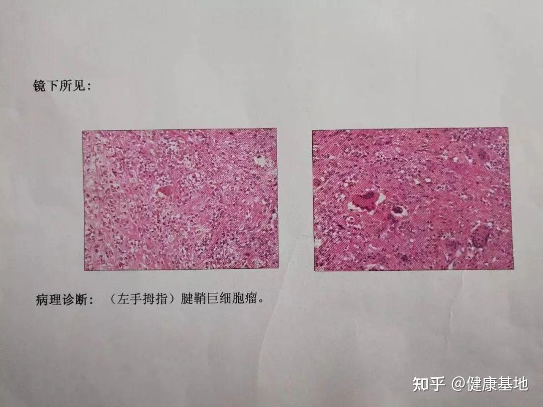 腱鞘巨细胞瘤病理图片