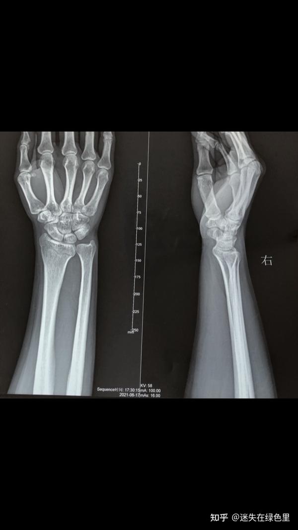 右手尺桡骨骨折多久能好 尺桡骨骨折多久手腕能转 尺桡骨骨折超过一年