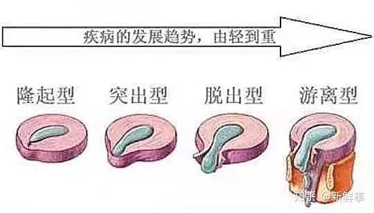 腰椎間盤突出並不意味著一定會引發症狀,只有當突出間盤壓迫到脊神經