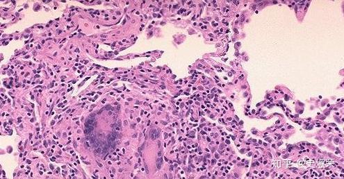 该病可由各种感染(如ebv,寄生虫)性疾病,血液疾病特别是淋巴瘤引起.