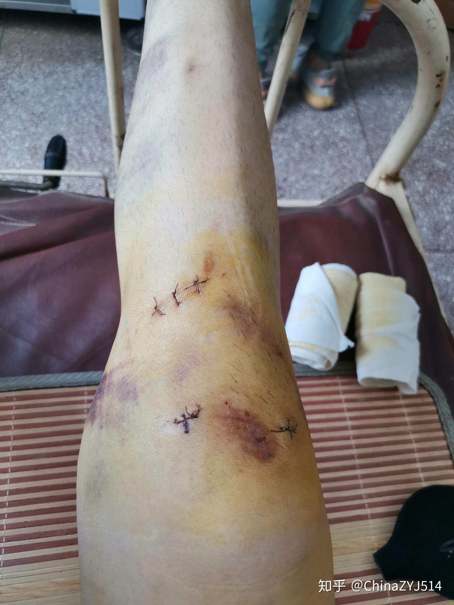 前交叉韧带断裂术前术后经历分享