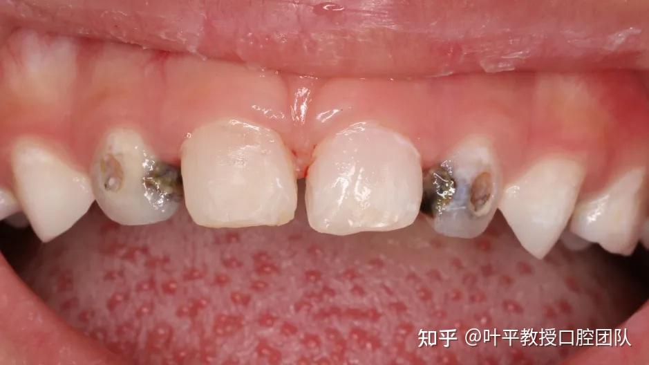 门牙龋齿各个阶段图片图片