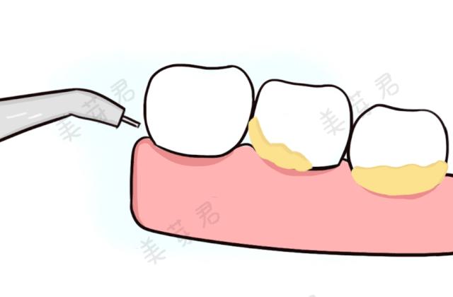 自己怎样洗牙齿 v2-5bc77ad43d11c45f6981a87630ec57a6_r.jpg