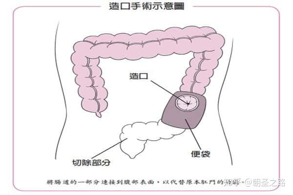 造口根据选择部位分为回肠造口,横结肠造口和乙状结肠造口