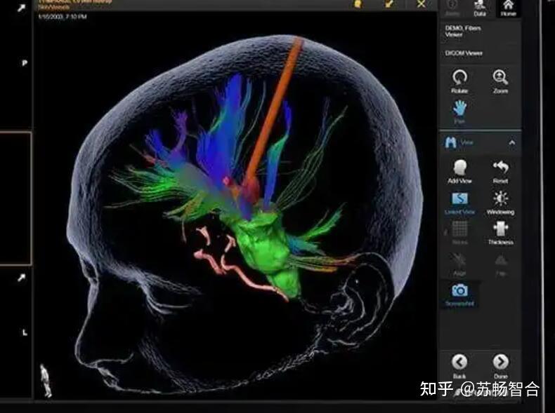 分享全球数字医疗领域冠军企业Brainlab是如何迅速崛起的？ - 知乎