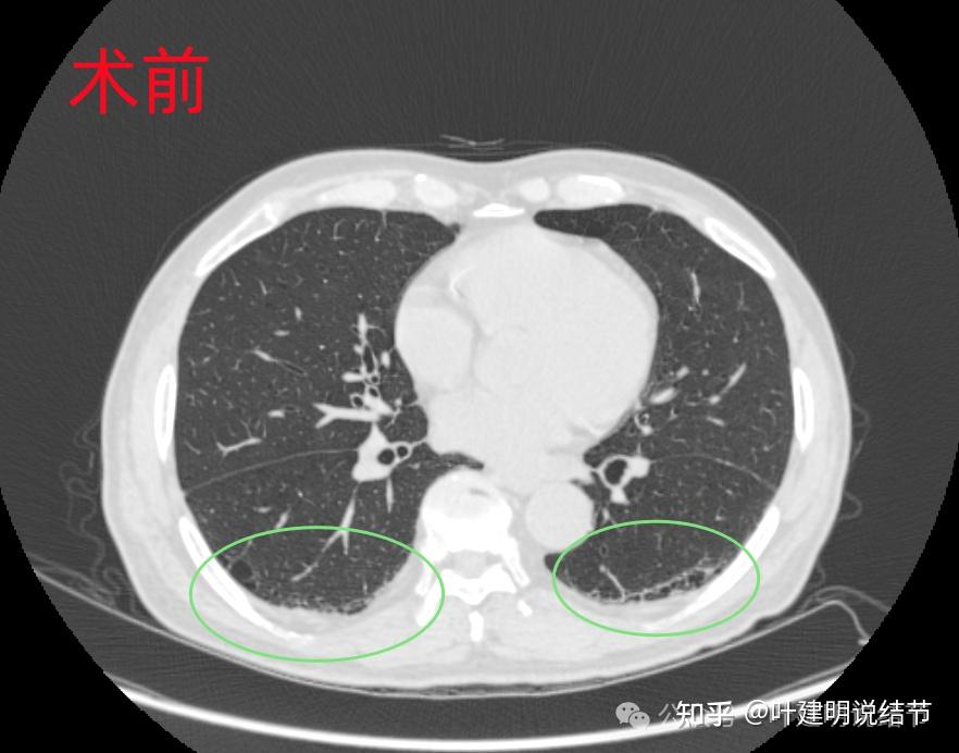 罕见病例剖析:微浸润性腺癌术后1年广泛转移?