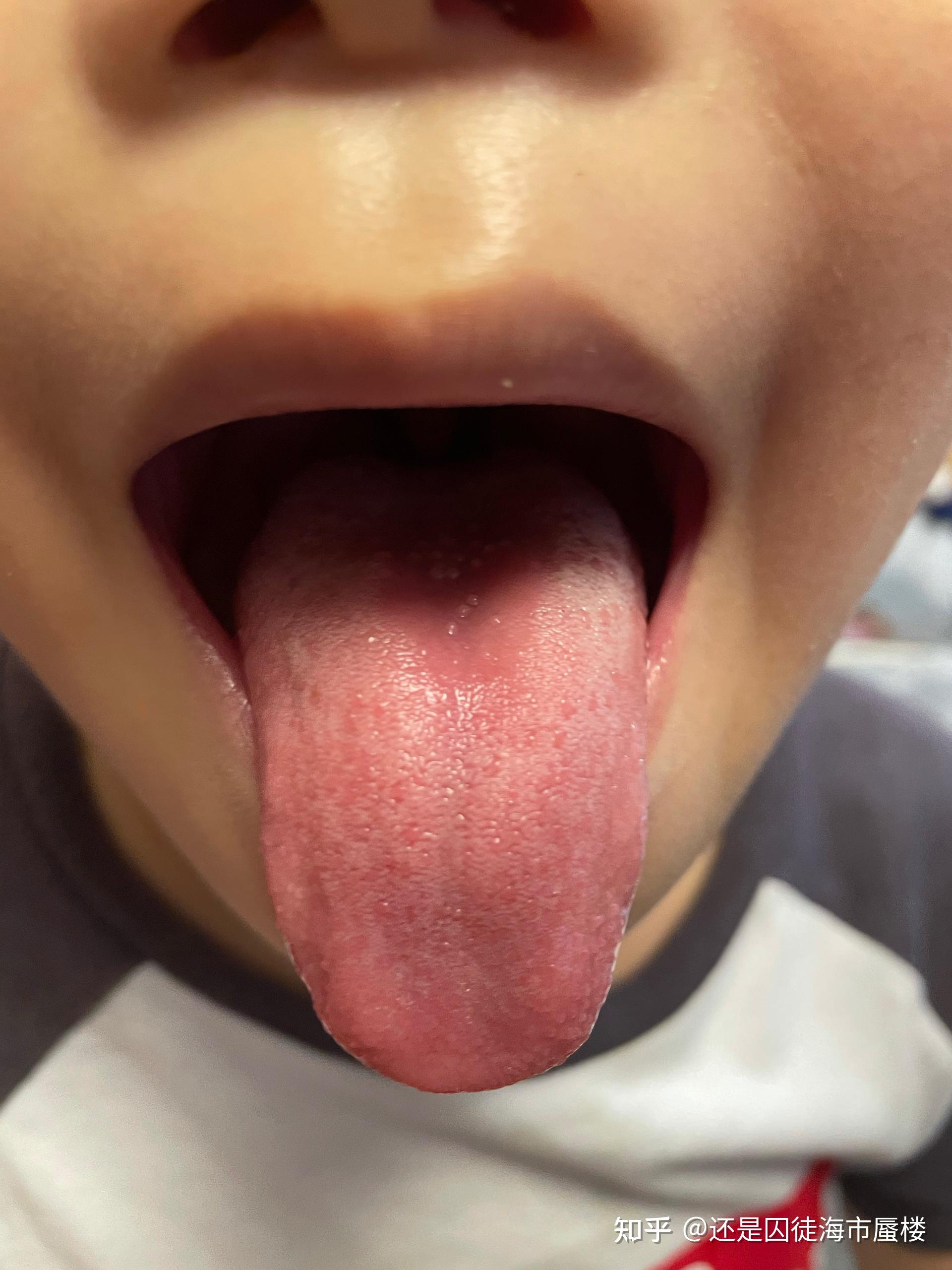 孩子舌头颗粒透明小泡图片