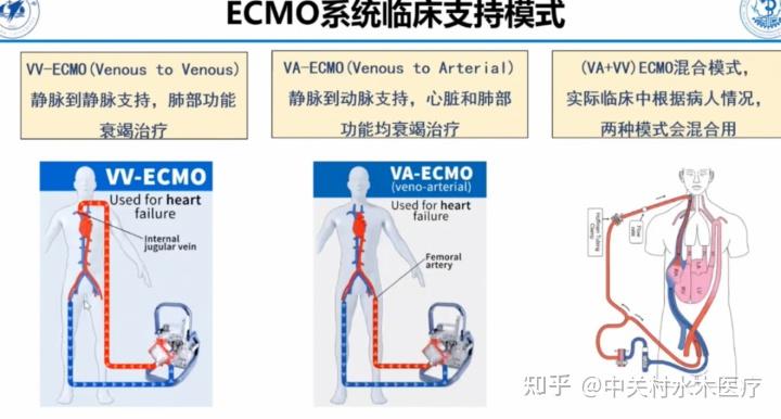 ECMO技术发展及市场产品情况解读 - 知乎