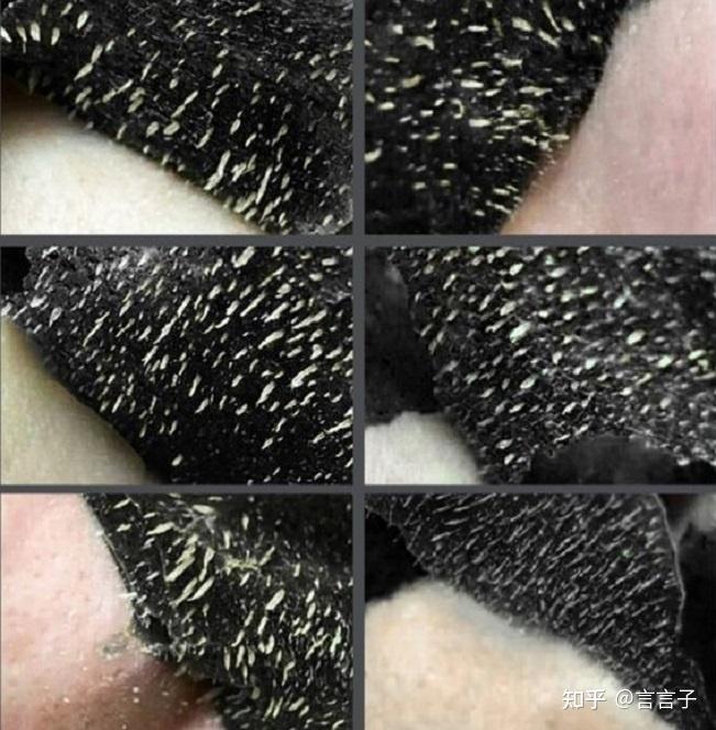 有没有去黑头粉刺见效特别快的产品?